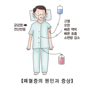 패혈증(Sepsis) | 질환백과 | 의료정보 | 건강정보 | 서울아산병원